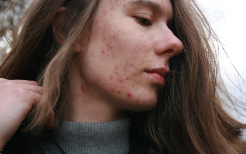 Skincare Considerations for Oily Skin