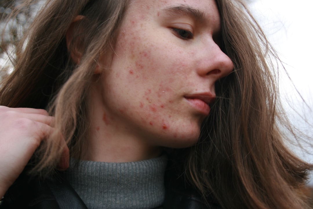 Skincare Considerations for Oily Skin